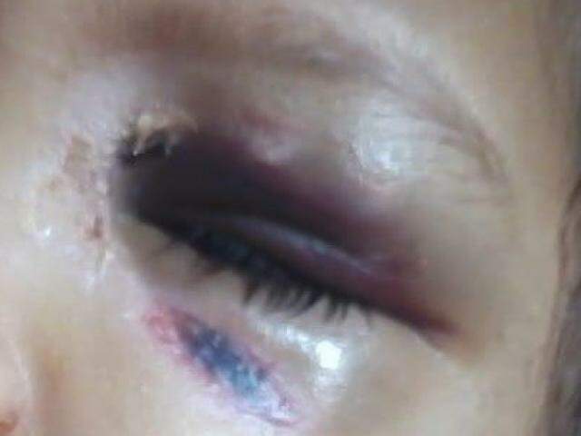 Menina de 3 anos está com olho roxo, aparente queimadura na boca e queda de cabelo. Tia nega agressões (Reprodução)