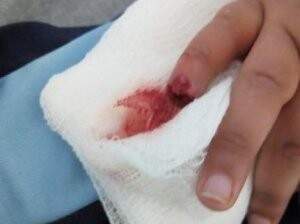 Criança teve amputação traumática e perdeu parte do mindinho da mão direita (Direto das Ruas)